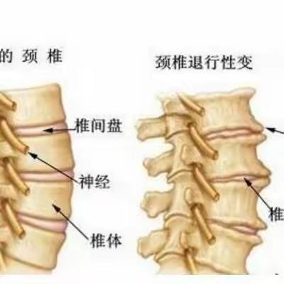 颈椎病相关知识