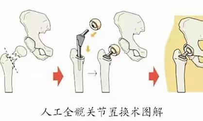 人工髋关节置换术的健康宣教