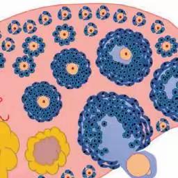 盆腔出血性囊肿TOP3
