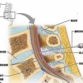 腰椎穿刺别紧张，其实没那么可怕