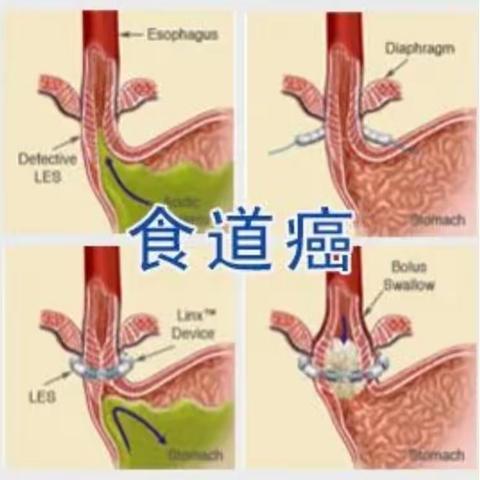 食管癌患者福音——入组2个免费临床试验