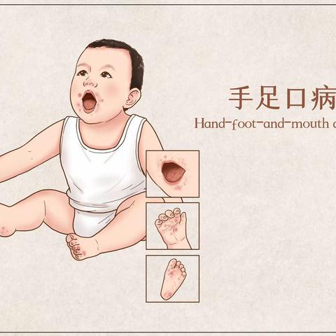 “手足口护理知识我知道”——胡桥路幼儿园秋季传染病防治知识普及