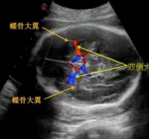 胎儿大脑中动脉的测量和评估
