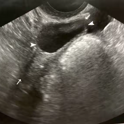 超声监测下的5种卵泡发育异常