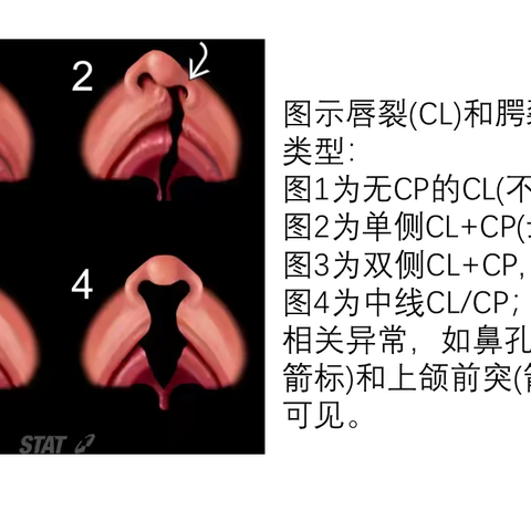 我院超声科唇腭裂病例分享