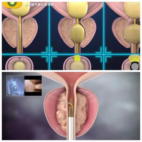 前列腺扩张术与Rezum的物理原理比较
