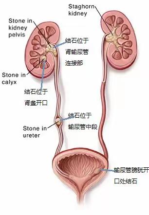 结石无处可逃——输尿管软镜手术