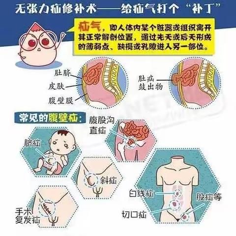 慧宜普外科—— 给疝气打个“补丁”