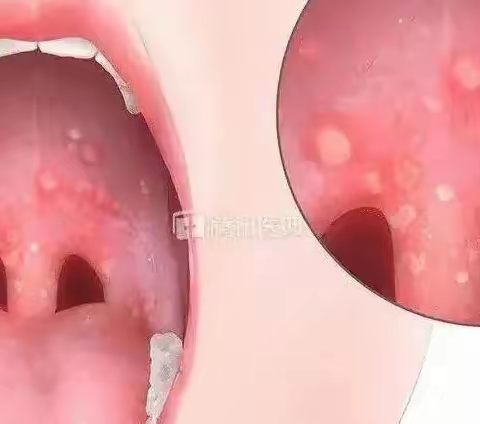 “预防疱疹性咽峡炎、水痘，守护儿童健康”