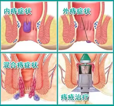 痔疮还可以这样治
