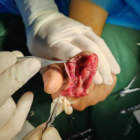 灵台县华仁医院手足外科成功实施复杂性“示指毁损伤”手术