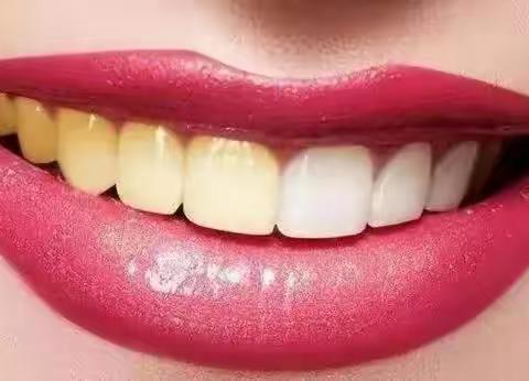 卓维雅口腔早报分享“牙齿美白对牙齿有伤害吗？”