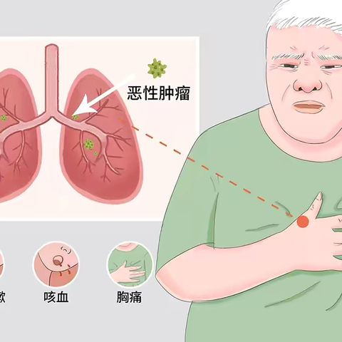 认识中国癌症发病率、死亡率之首——肺癌