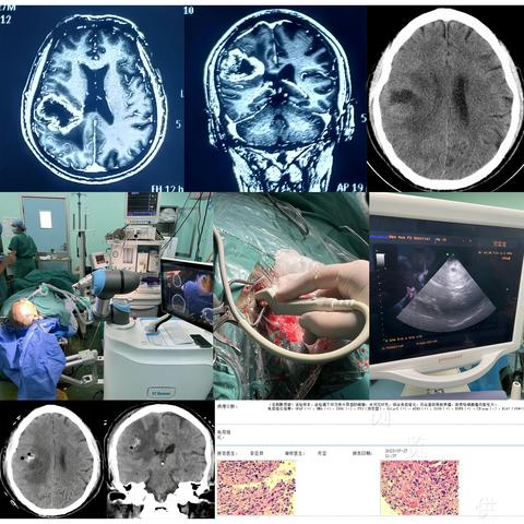 机器人辅助下的神经外科手术-南华大学附属第二医院神经外科一周工作纪实
