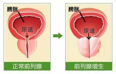 前列腺增生术后护理