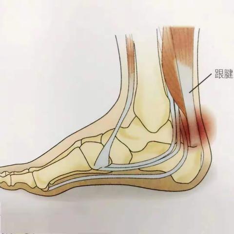 【周医·骨科】重视跟腱炎，让你走出稳健步伐！