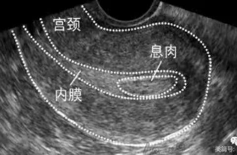 子宫内膜息肉超声诊断