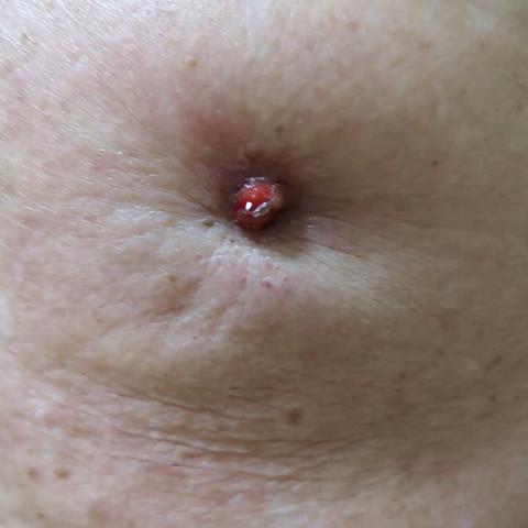 并不罕见的 男性乳腺癌