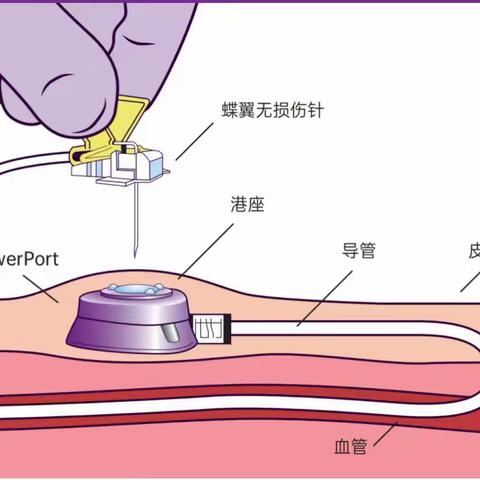 邓州市中心医院成功开展上臂完全植入式静脉输液港植入术   −−打通肿瘤患者“隐形生命通路”
