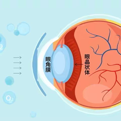 火爆暑期的OK镜是什么？又该如何选择合适自己角膜塑形镜。