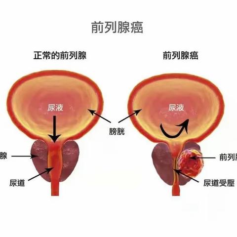 前列腺癌根治术围手术期护理