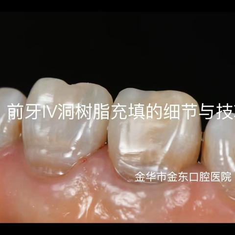 四类洞充填技巧