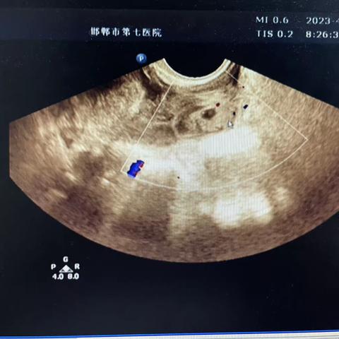 强医技 助临床——超声医学科急诊之异位妊娠