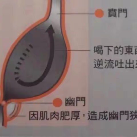 新生儿呕吐疾病——先天性肥厚性幽门狭窄