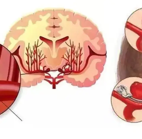 一颗埋在脑内的炸弹——颅内动脉瘤