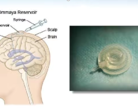 脑积水的最新手术方式--OMMAYA囊