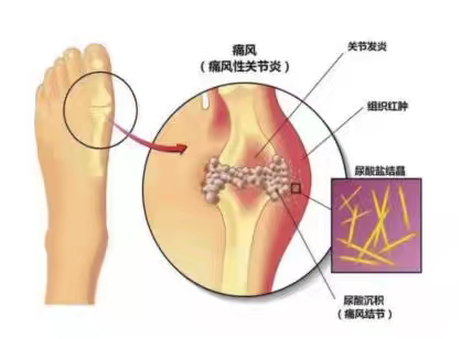 痛风患者不用愁，中医刘主任帮您摆脱痛风折磨
