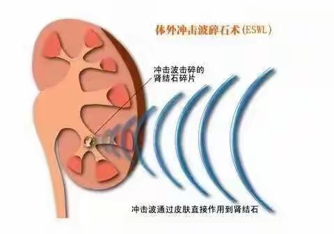 体外冲击波碎石术——泌尿外科的秘密武器，让“石头”不再疯狂