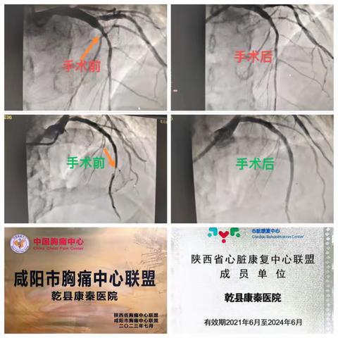 乾县康秦医院再次成功完成2例心脏冠脉造影及支架植入术