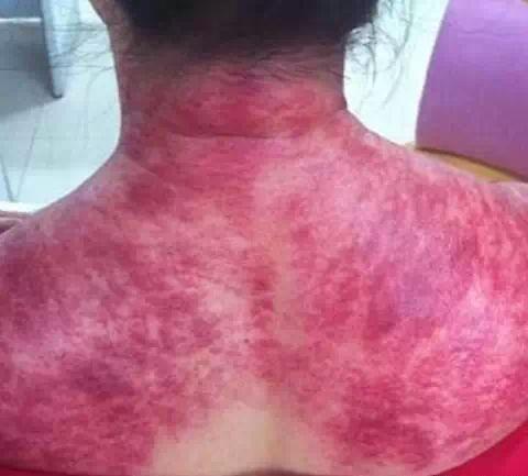 肩颈是毒素最易堆积的地方，不疏通就是这样子！