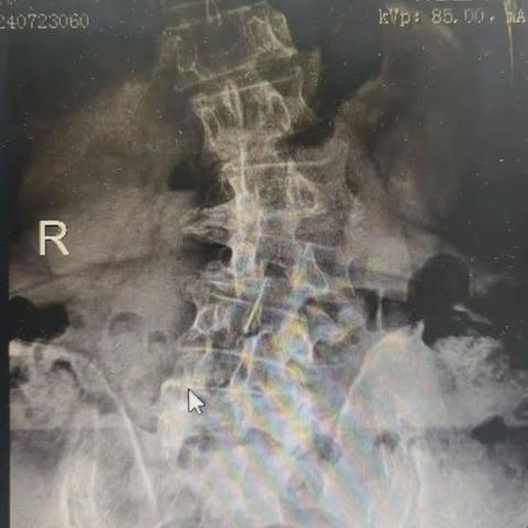一例多节段腰椎管狭窄合并腰椎侧凸的治疗选择