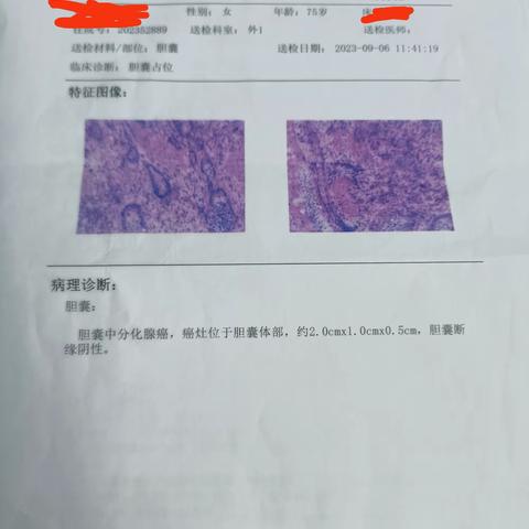 精准治胆，用心护肝_太和县肝胆外科再次独立完成胆囊癌根治术