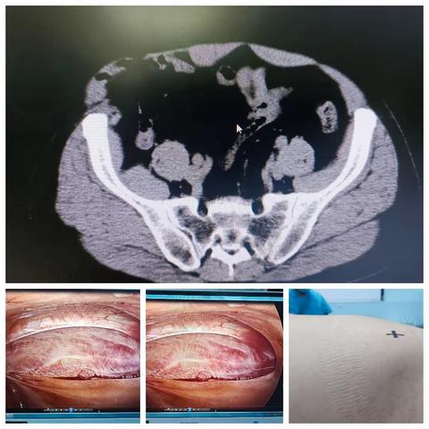 广结疝缘，日行疝事_太和县中医院外一科独立完成首例腹腔镜腹膜前半月线疝修补术