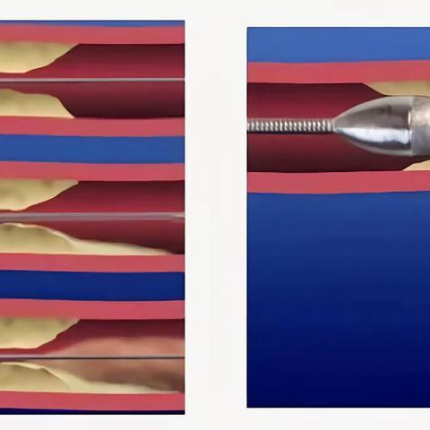 冠状动脉旋磨术——为患者打通“生命路”