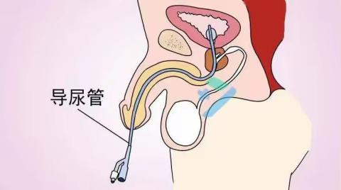 留置导尿居家护理方法