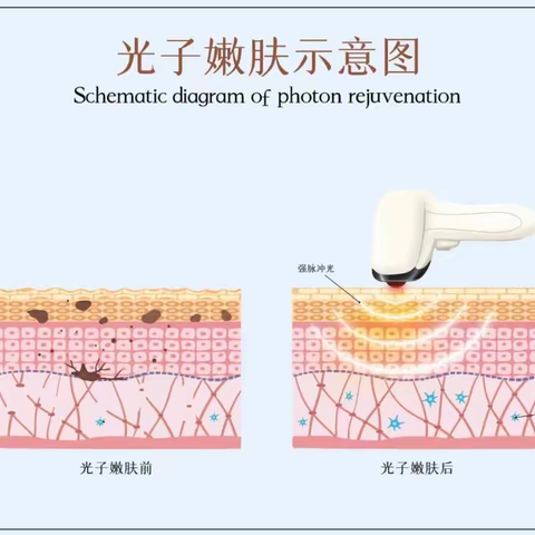 【科普】美肤界的“十全大补汤”——光子嫩肤
