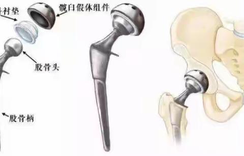 【康复医学科科普】带您了解骨科术后康复