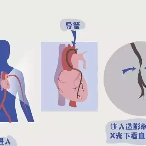 【DSA介入】诊断冠心病的“金标准”