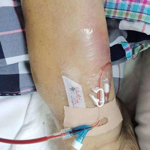 滨州市中心医院重症医学科【青年文明号】为输液困难户建输血通路