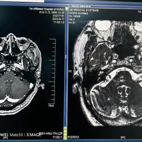 呈贡病区32床术后汇报