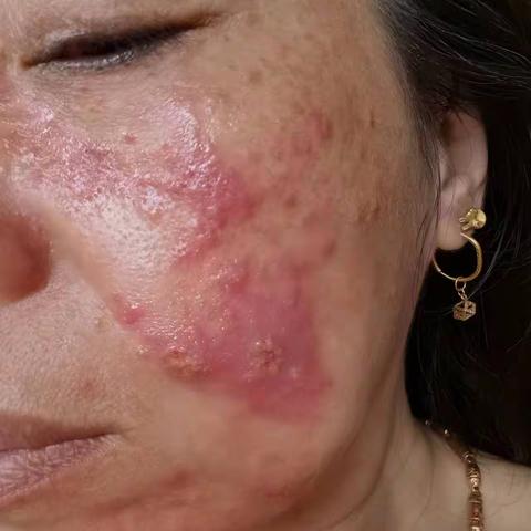 经历过烂脸的痛苦吗？