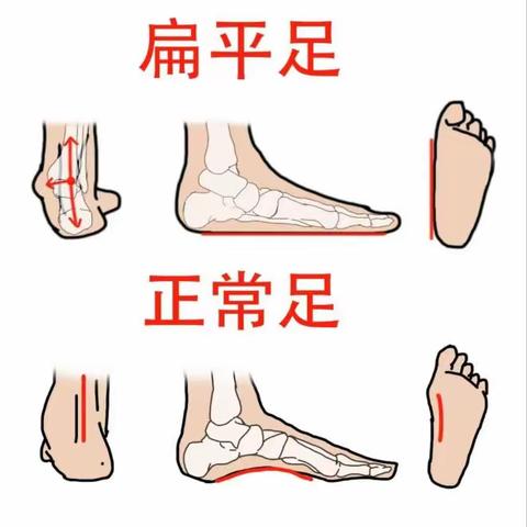 千里之行，始于足下 --儿童扁平足