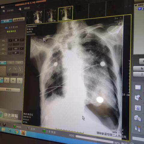 成功抢救一例自发性气胸