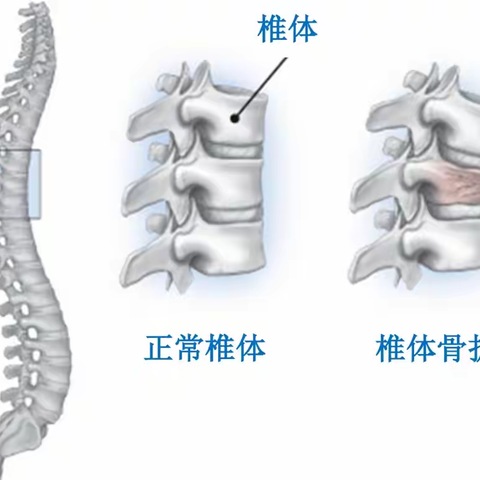 您不知道的骨折—脊柱压缩性骨折