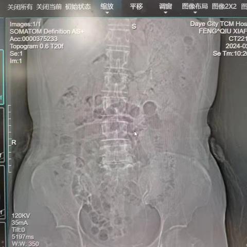 留置双J管的注意事项