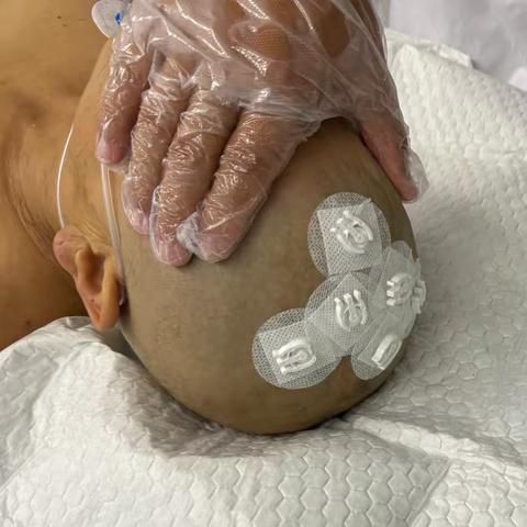 邓州首例！人民医院神经外科手术机器人大显神威！